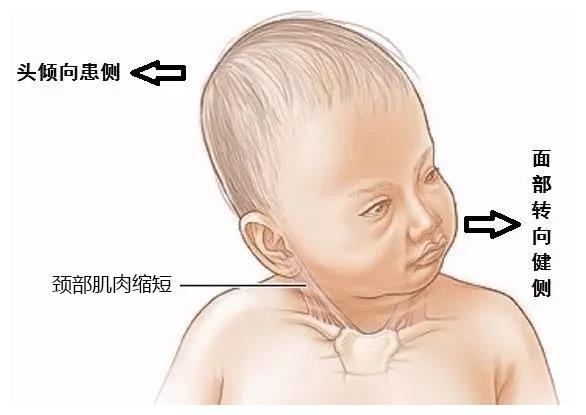 关于六个月宝宝脖子有点歪的问题分析