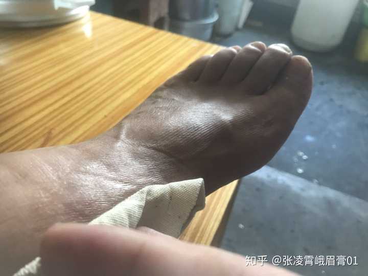 脚崴了三个月仍不见好转，原因何在？